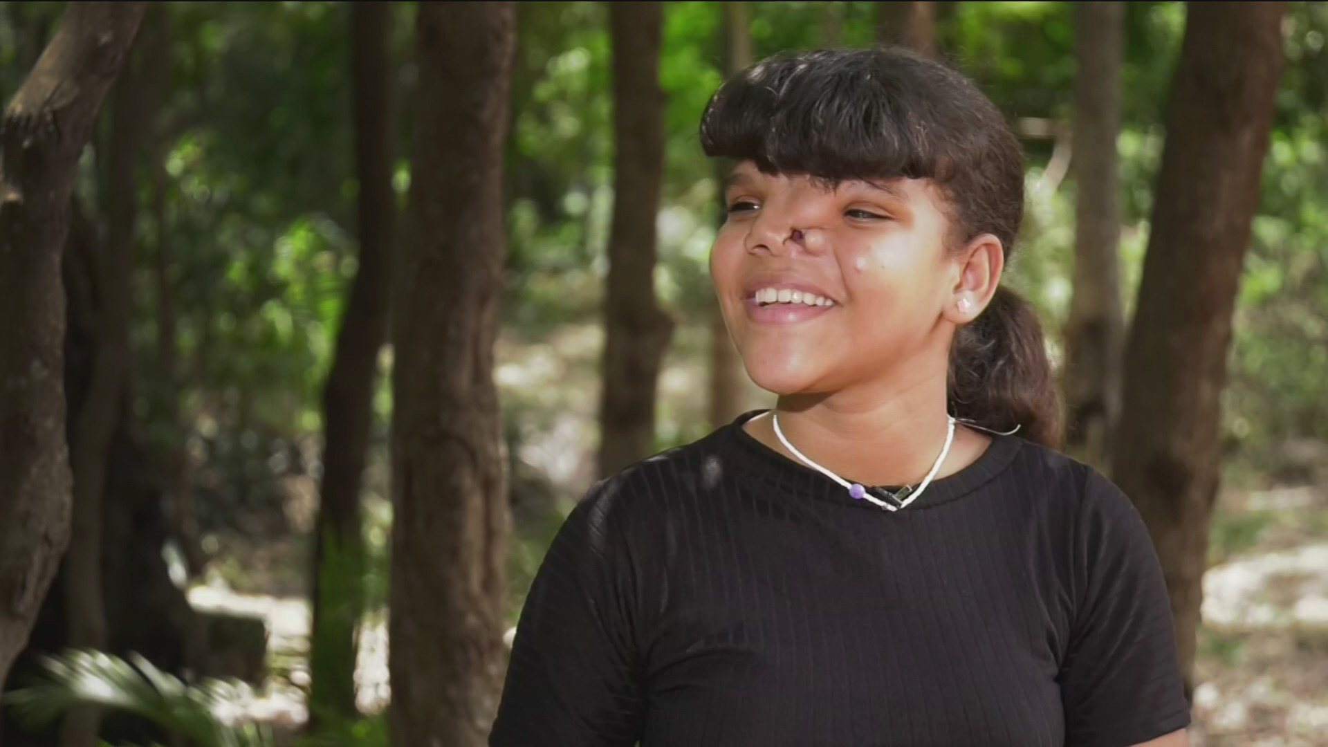 Ayuda de Impacto Niña con malformación en su rostro ha recibido burlas