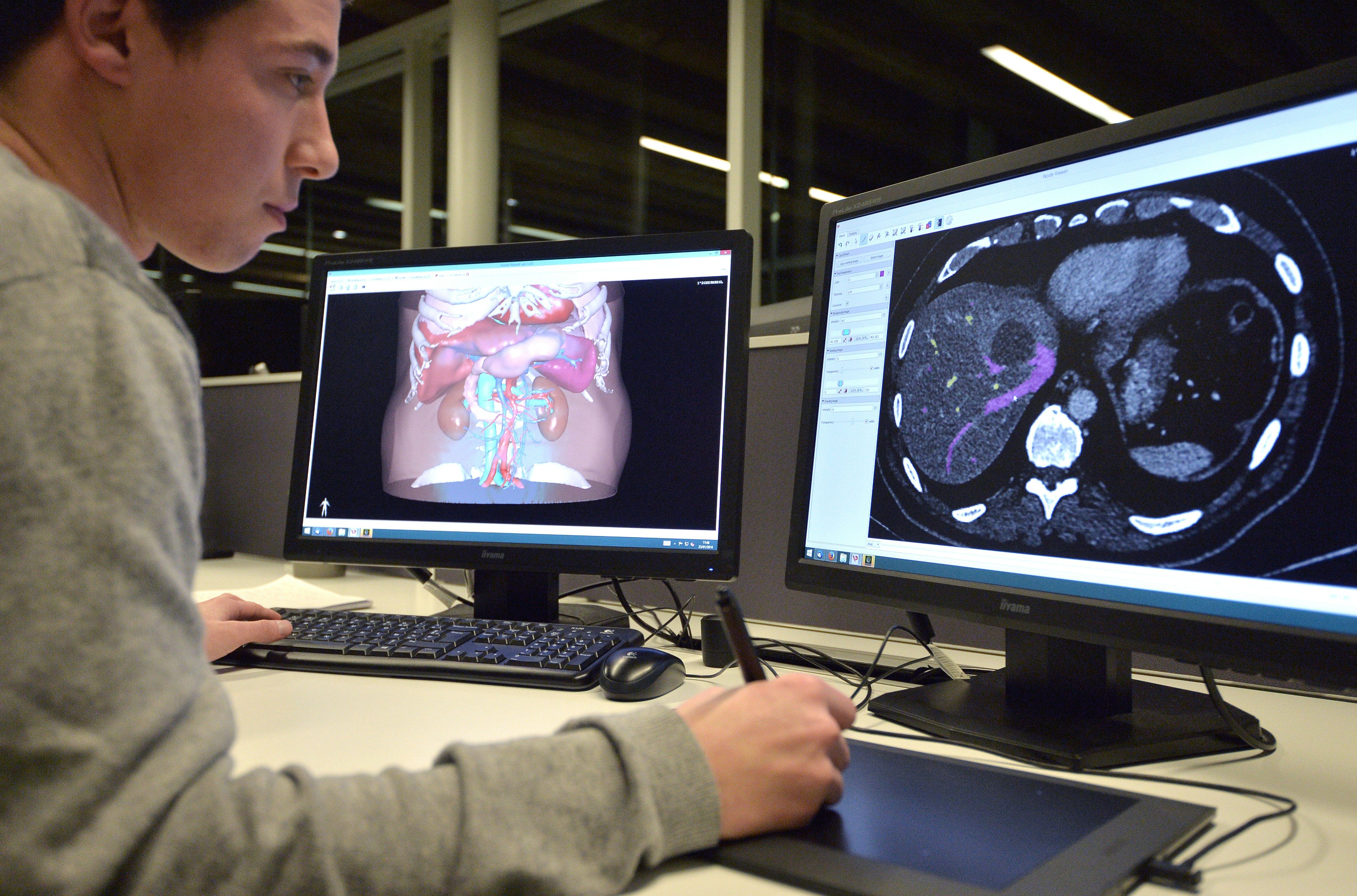 tratamiento de prostata con laser