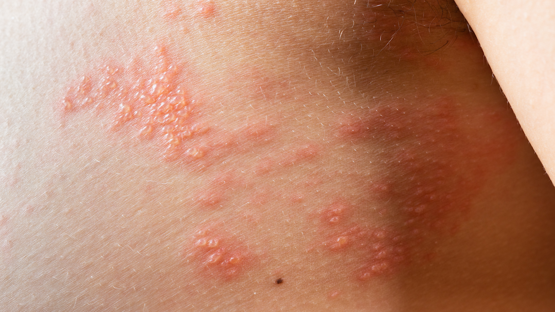 La culebrilla: qué es, qué hacer si la tiene, cuáles son sus síntomas y  tratamientos | Univision 34 Los Angeles KMEX | Univision