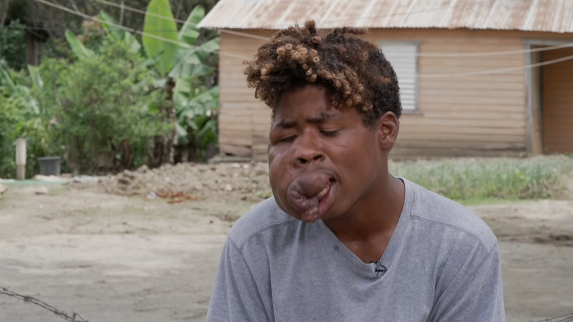 Ayuda de Impacto Joven tiene un tumor en su rostro Shows Primer Impacto Univision