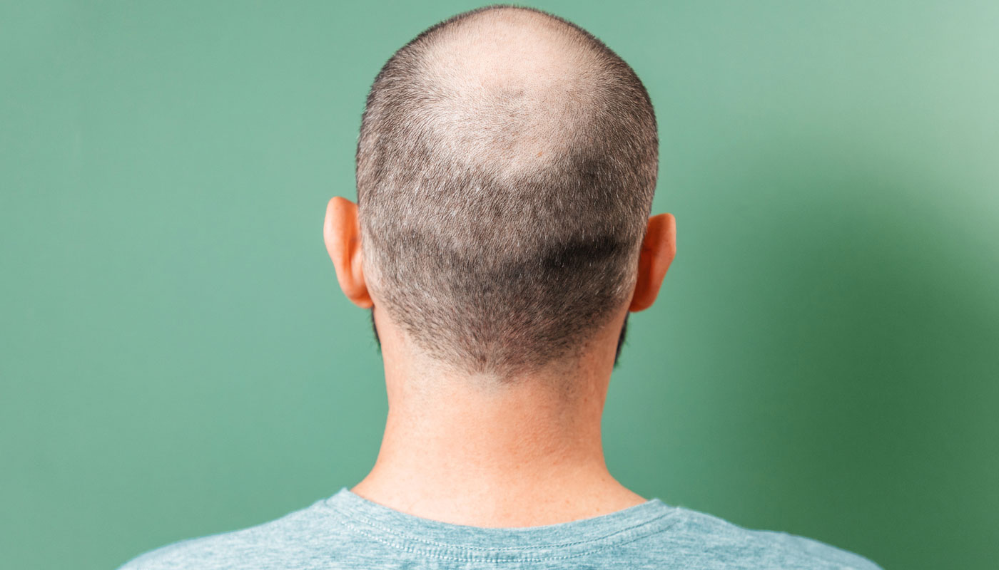 Propecia Más Barato