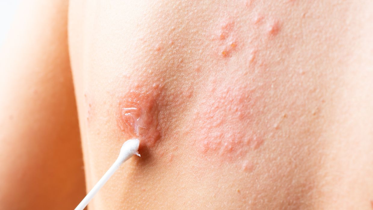 Culebrilla o herpes zóster: una enfermedad común que se activa con el estrés | Estilo de Vida Bienestar | Univision