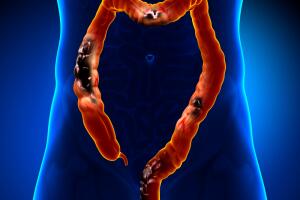 cancer-colo-reto-0716.jpg