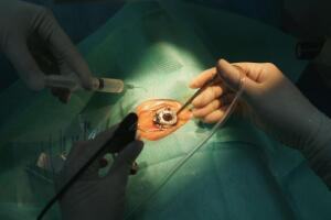 Cirurgia a laser