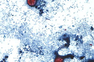 Cyclospora Outbreak