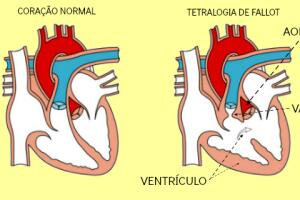 coracao-tetralogia-fallot.jpg