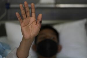 Monkeypox