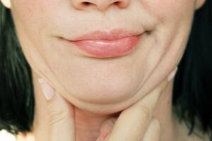 Cómo evitar que me salga papada