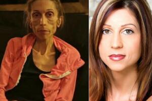 como-tratar-anorexia-1.jpg