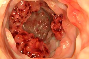 cancer-no-intestino-0417-1400x800.jpg