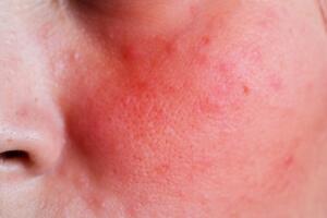 pele-vermelha-rosacea-0119-1400x800.jpg
