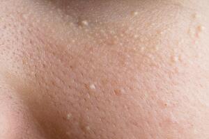 milium-sebaceo-pele-0117-1400x800.jpg