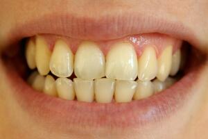 sorriso-dentes-amarelados-0118-1400x800.jpg