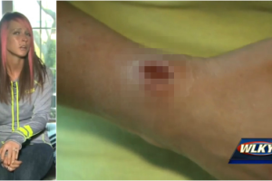 infeccao-no-braco-2.png