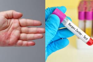 culebrilla_herpes zóster_síntomas