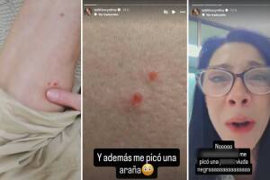 Cynthia Klitbo fue hospitalizada de emergencia por la mordedura de una araña viuda negra