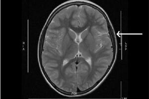 RUB medics discover unique method to detect babies at high-risk for white matter brain damage