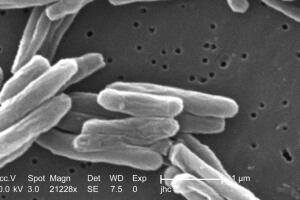 Tuberculosis