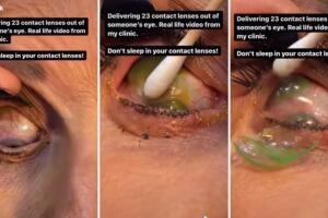 Doctor retiró 23 lentes de contacto del ojo de una mujer