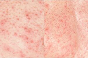 foliculite-pele-vermelha-1116-1400x800.jpg