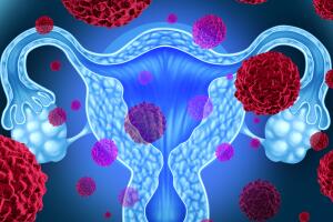 endometriose-utero-0117-1400x800.jpg