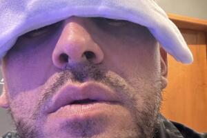 Juan Rivera mostró cómo se cuida en la convalecencia tras el injerto capilar al que se sometió.