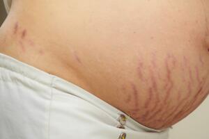 estria-barriga-gravida-0218-1400x800.jpg