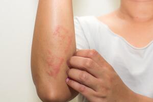 psoriasis-efecto-psiquico.jpg
