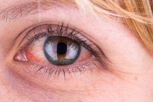 ojos-rojos-shutterstock_503553316.jpg