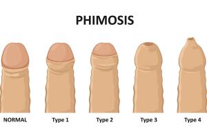 fimosis.jpg