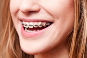 dentes-aparelho.jpg