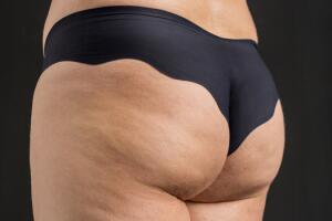 tratamento-celulite-socos-bumbum.jpg