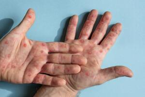 Aumentan los casos de Mpox en el condado de Los Ángeles: Salud Pública exhorta a vacunarse