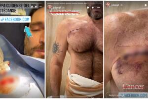 Julián Gil muestra la cicatriz que le dejó el cáncer de piel