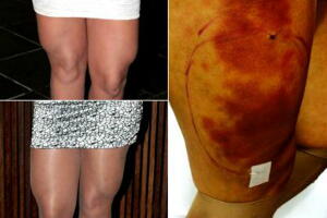 andressa-urach-cirurgias-coxas_0.jpg