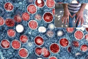 transmision viruela.jpg