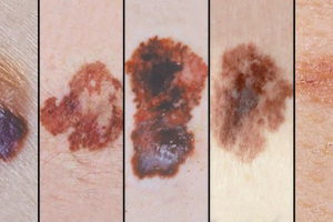 melanoma.png