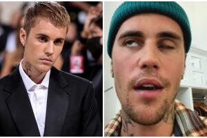 Justin Bieber revela que sufre parálisis facial debido a una enfermedad 