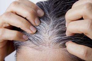 Young woman with white hair problem