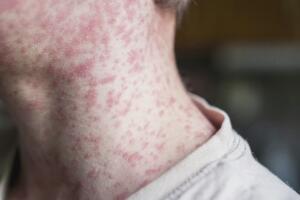 Lo que dice un experto sobre el uso de vitamina A como tratamiento del sarampión.