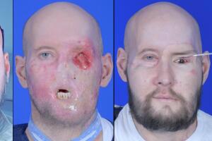 Progreso cirugía James Aaron