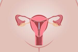 diu-no-utero-da-mulher-0717-1400x800.jpg