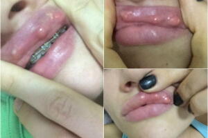 aumentar-os-labios-2.jpg