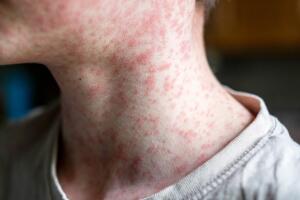 Sarampión en California: ¿Cuál es la situación actual y cómo prevenirlo?