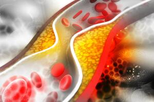 colesterol-alto-arterias-1218-1400x800.jpg