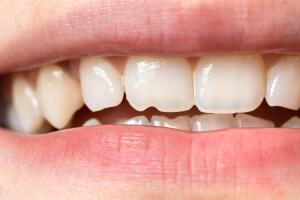 dente quebrado