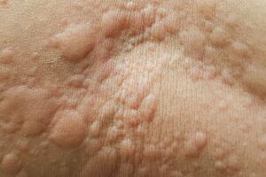 urticaria-coceira-corpo-1217-1400x800.jpg