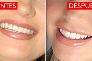 dientes nuevos ok.jpg