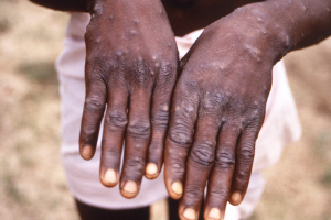 viruela del mono.png