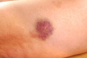 hematoma-roxo-2_0.jpg